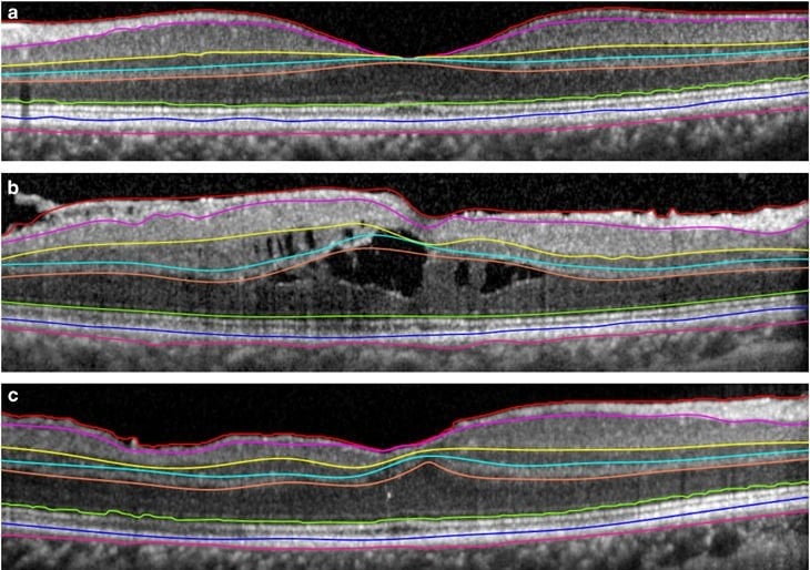 Hecht Et Al Nature Eye 2017 Layers Only