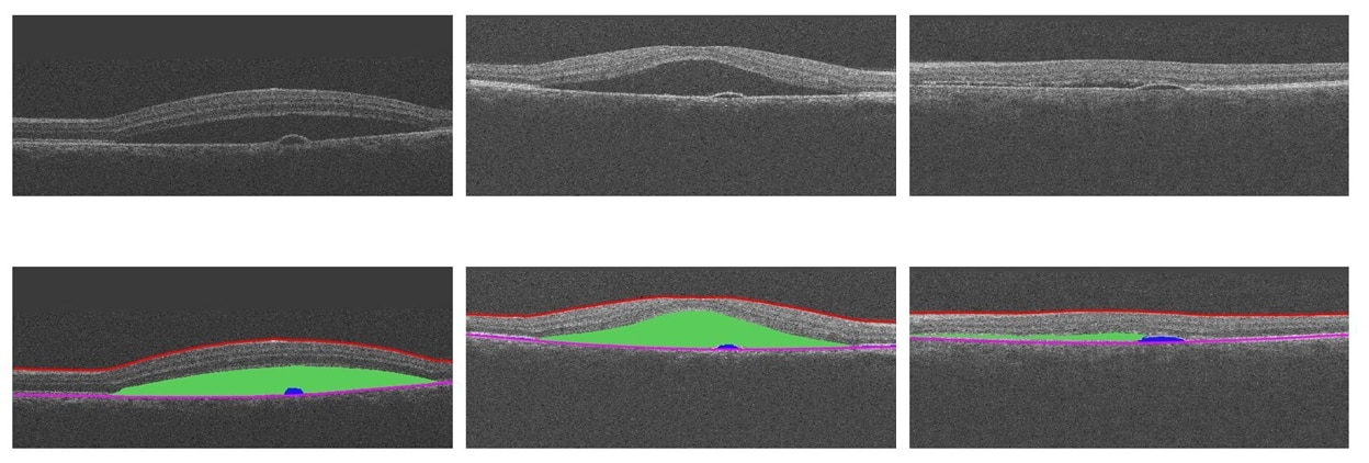 OCT fluid segmentation large